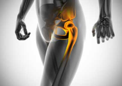 Hip Replacement Surgery in Lucknow